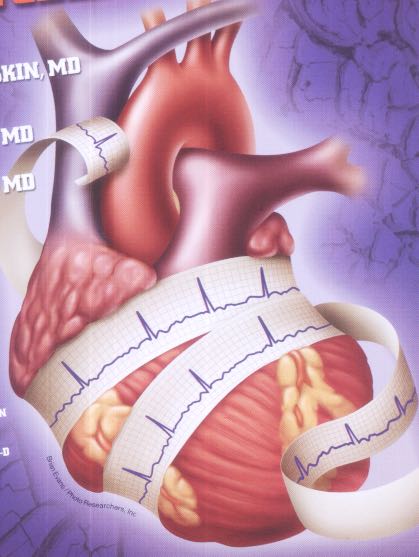 Infarto silencioso: veja os riscos e como se prevenir - Vitat